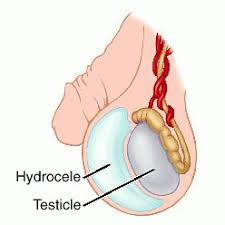 Hydrocoele (Scrotal  Swelling)
