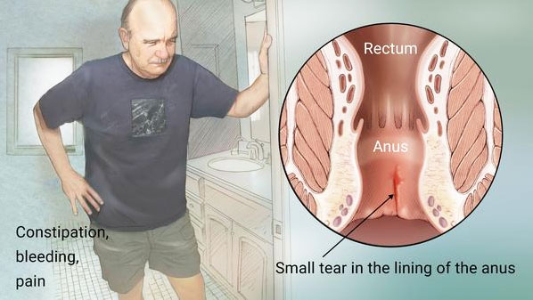 Anal Fissure