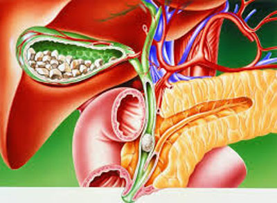 choledocholithiasis